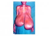 Click to view big image abelena.com_39690711_bilateral_breast_hypertrophy.jpg